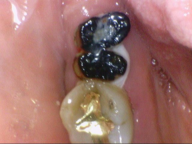 [서울시청역/남대문]어금니임플란트+상악동거상술(뼈이식):실제케이스 관련 이미지 4