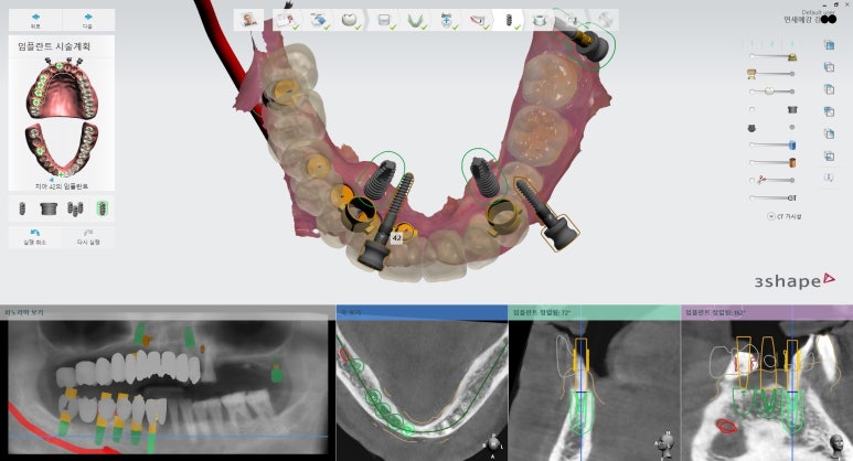 [북창동 치과/연세예감치과]내비게이션임플란트소개 관련 이미지 12