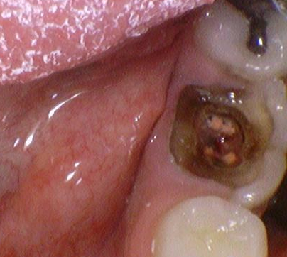 시청역치과, 신경치료 하고 크라운 꼭 해야하나요? 관련 이미지 1