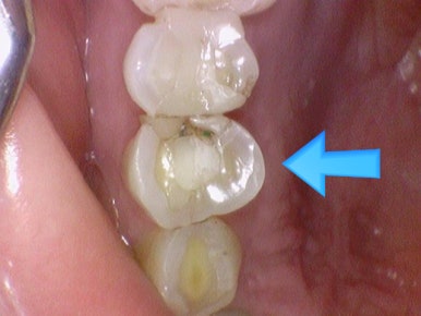 치아가 충치나 크랙으로 지르코니아 크라운을 해야한다면? 구강스캔사용치과의 지르코니아크라운 설명 관련 이미지 4