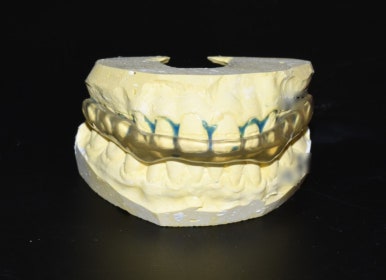 Teeth grinding, Bruxism: Botox, Night Guard in Seoul /  price 관련 이미지 2