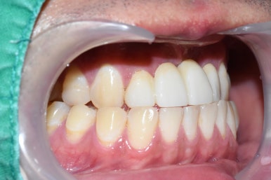 넘어져서 또는 부딪혀서 앞니 아주 많이 부러진 경우, 시청역치과 실제 앞니브릿지케이스 관련 이미지 12