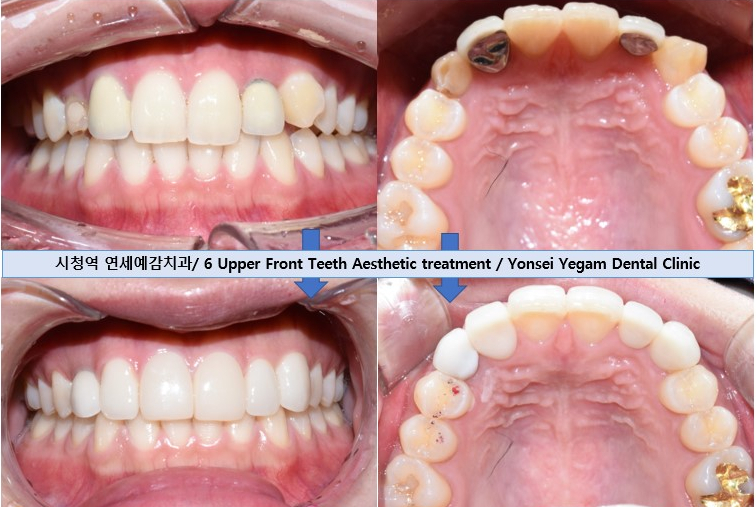 [서울역/치과] 왜소치와 옥니에 특히 추천드리는 무삭제 라미네이트! 관련 이미지 4