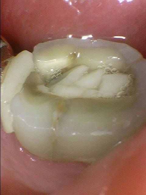광화문 시청치과 치아가 쪼개졌어요 실제사례 관련 이미지 8