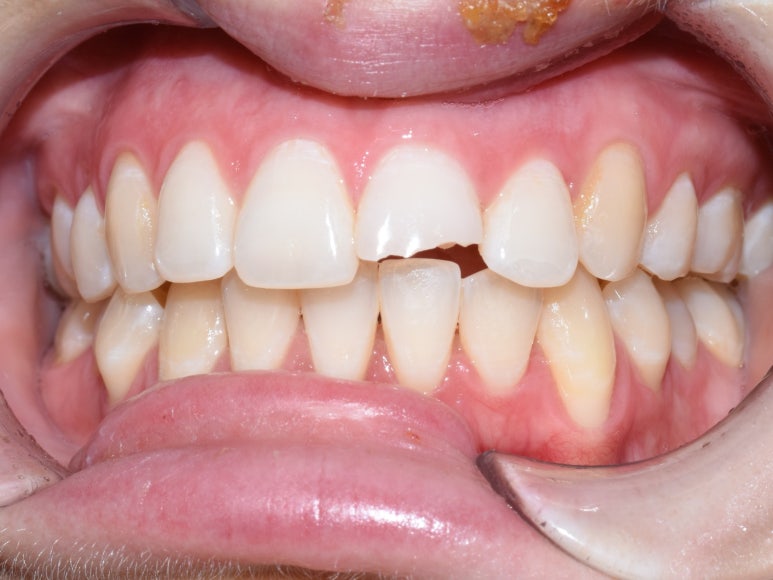 [광화문/연세예감치과] 앞니 치아가 파절되었다면? 앞니 부러짐.레진/크라운/임플란트 관련 이미지 3