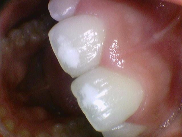 반점치, 반상치, 치아에 하얀 점 치료방법 전후사진, 가격 비용까지 관련 이미지 3