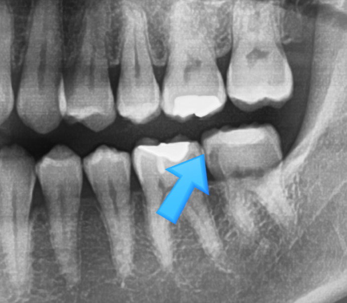 보여주는 충치치료, 믿고 치료받으세요. 서울시에서도 인증한 해외에서도 찾아오는 시청역치과 관련 이미지 4
