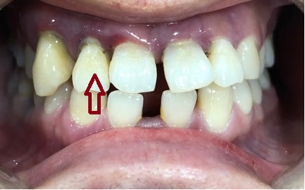시청역치과 벌어진 앞니를 바르고 이쁘게! 대한심미학회회원치과 관련 이미지 4