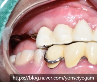 시청역 임플란트&상악동수술?상악동거상술? 어떻게 진행되었을까요 관련 이미지 4