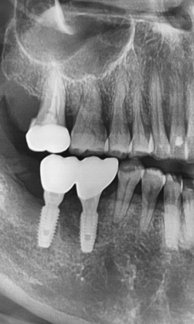 오래된 임플란트가 흔들려요 인플란트 재수술도 서울역가까운치과 연세예감치과 관련 이미지 14