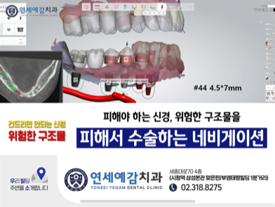 충정로 내비게이션 임플란트 알려드려요 관련 이미지 3