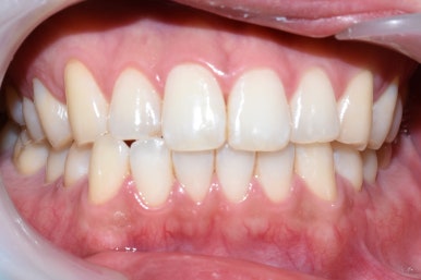 치아미백, 치과에서 하면 얼마나 오래갈까? 궁금하시다면, 실제사례 바탕으로 알아보아요 지속,유지 관련 이미지 3