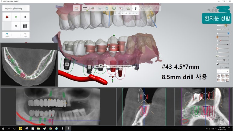 [시청역/을지로] 임플란트 진단 상담 비용? 관련 이미지 6