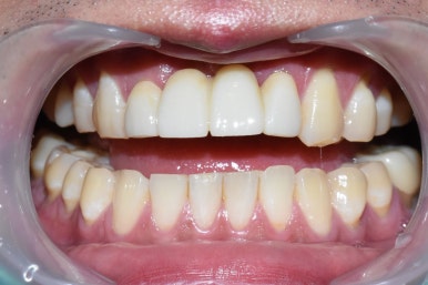 넘어져서 또는 부딪혀서 앞니 아주 많이 부러진 경우, 시청역치과 실제 앞니브릿지케이스 관련 이미지 10