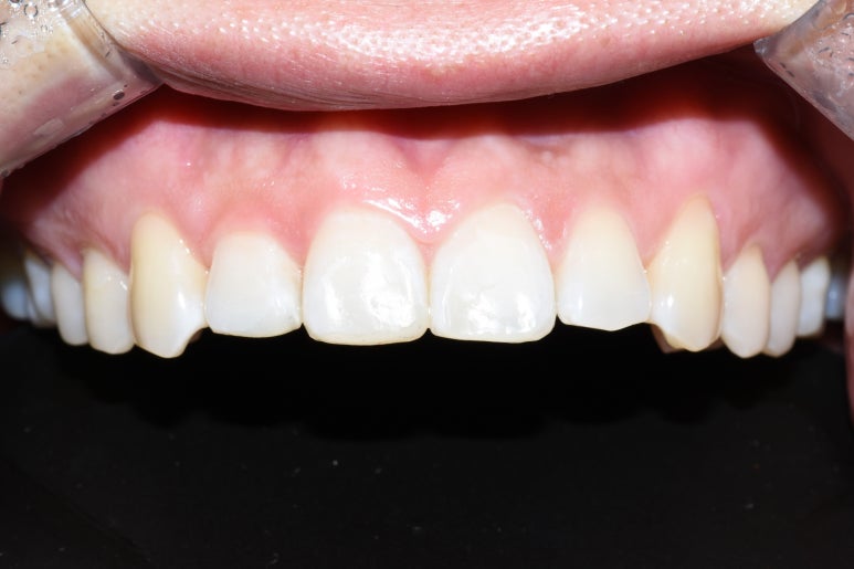 [서울역/치과] 앞니가 조금 아주조금 깨졌어요 치료가능한가요? 관련 이미지 7