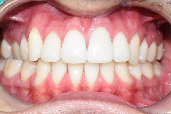 [광화문/치과] 외국인환자 변색된 앞니 하나의 크라운 치료 실제 케이스 관련 이미지 4