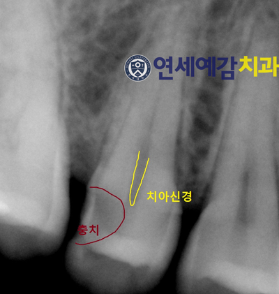 시청역치과 시청치과 자연치아살리기 <연세예감치과> 관련 이미지 6