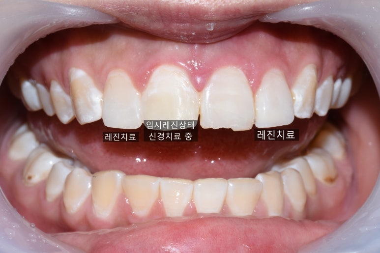 [서대문가까운/치과] 깨진 치아 레진 떼운 사례 관련 이미지 6
