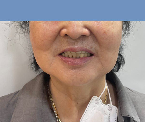 [서울시청역,서울역/남대문] 틀니를 임플란트로. 전체임프란트 실제 사례 관련 이미지 6
