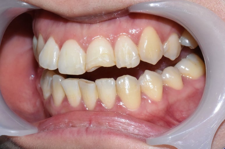 깨진 치아 레진치료 방법 실제사진 관련 이미지 1