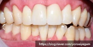 Q&A) 치아가 간지러워요 관련 이미지 6