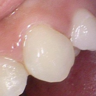 [서울역/시청역] 충치 & 화이트 스팟 (반점치) 의 레진치료케이스 관련 이미지 2