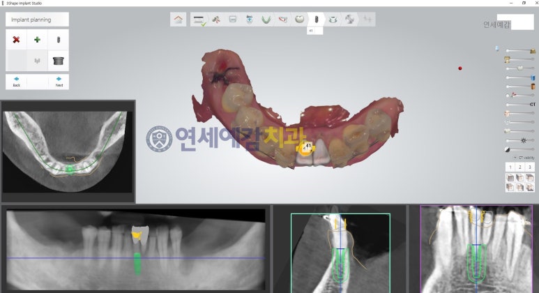 서울 시청치과 시청역/독립문치과 네비게이션임플란트 <연세예감치과> 관련 이미지 4