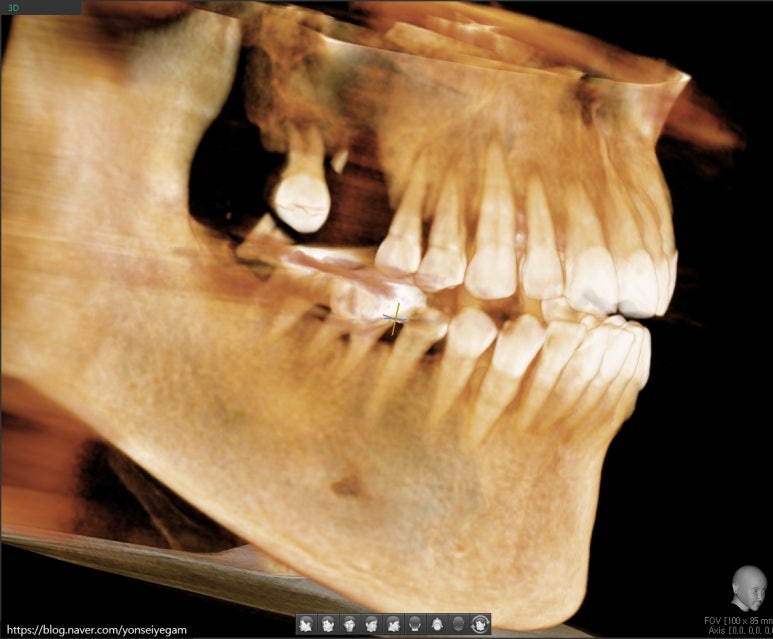 [서울시청역/남대문]어금니임플란트+상악동거상술(뼈이식):실제케이스 관련 이미지 5