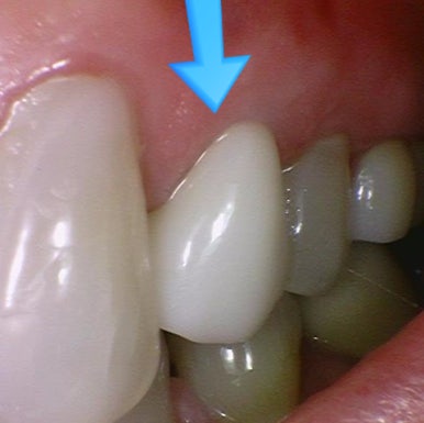 시청역 크라운 붙이기까지. 구강스캔으로 너무 길지도 짧지도 않게 3일째 가능합니다. 가격안내 관련 이미지 4