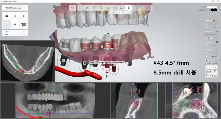 시청역 광화문  최소절개 또는 비절개로 가능한 네비게이션 임플란트 유명한 치과 내비게이션소개드려요 관련 이미지 13