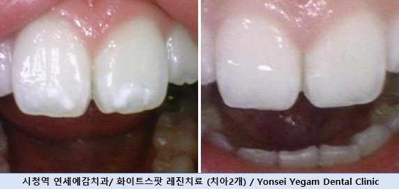 반점치, 반상치, 치아에 하얀 점 치료방법 전후사진, 가격 비용까지 관련 이미지 7