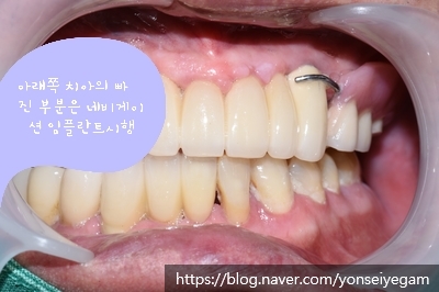 시청역,광화문 직장인에게 필요한 빠른 임플란트! 수술이 무서운 어르신들에게 만족도 높은 임플란트! 관련 이미지 8