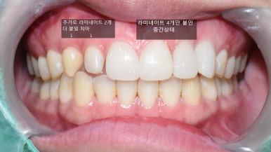 서울 시청역/서울역/ 벌어진 앞니, 왜소치 라미네이트 유명한 치과/ 전후 비교와 가격 관련 이미지 8