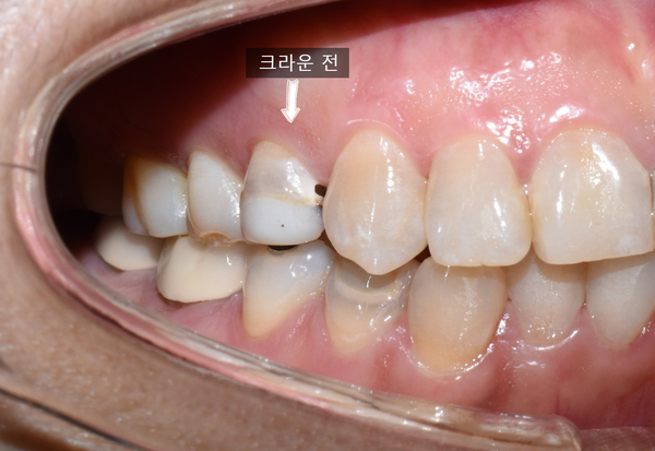[광화문/치과]어금니 금니,아말감이 보기싫다면? 이맥스 인레이 또는 지르코니아 크라운 관련 이미지 10