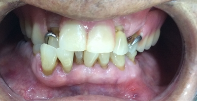 남대문시장가까운치과, 명동,서울역&용산가까운치과, 틀니치료 사례 관련 이미지 14
