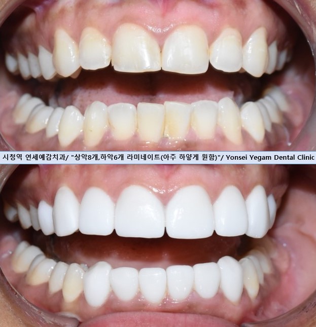 아주 하얀 치아를 만들고 싶어요 라미네이트케이스 및 비용 안내 관련 이미지 4