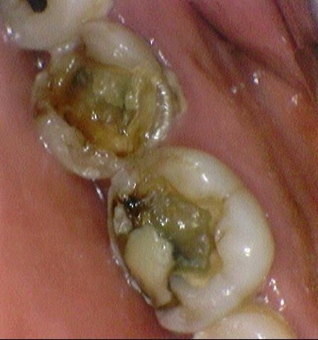 시청역치과/ "금니크라운이 보기싫은데 바꿀 수 있나요?" 관련 이미지 5