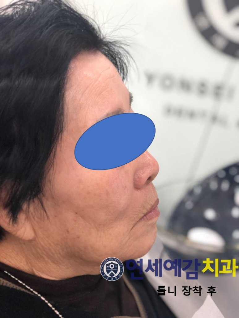 서울 틀니제작, 틀니치료 실제 예입니다. 시청역<연세예감치과> 관련 이미지 6