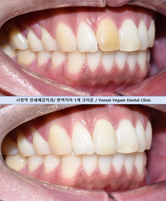 앞니전문으로 외국인들이 찾아오는 연세예감치과에서 알려 드리는 하나만 변색된 앞니의 크라운치료 관련 이미지 2