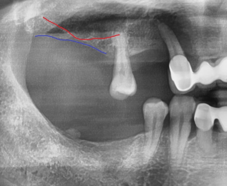 [임플란트/서울역] 서울 상악 전체인플란트 실제사례.극한의 케이스도 관련 이미지 5