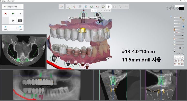 시청역 광화문  최소절개 또는 비절개로 가능한 네비게이션 임플란트 유명한 치과 내비게이션소개드려요 관련 이미지 9