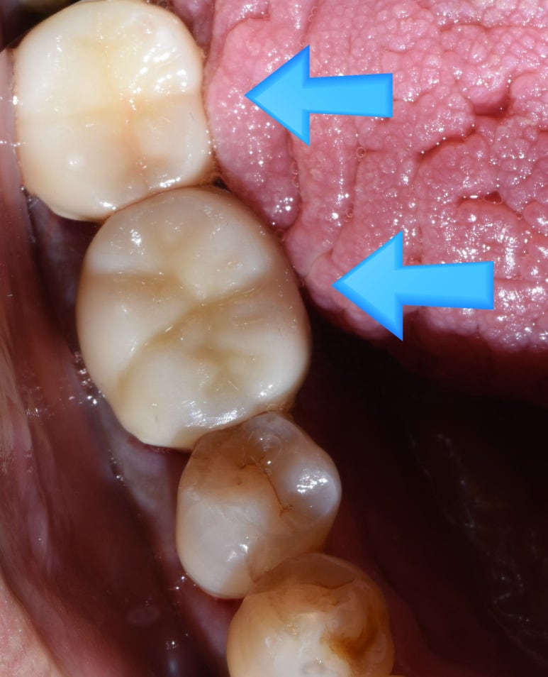 치아가 충치나 크랙으로 지르코니아 크라운을 해야한다면? 구강스캔사용치과의 지르코니아크라운 설명 관련 이미지 3