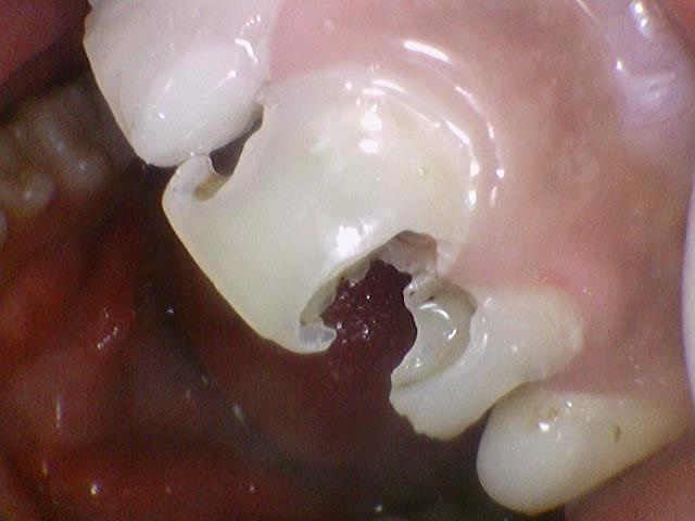 시청역치과 치아가 부러졌어요 치아가 너무 많이 썩어서 앞니가 거의 없는 치아의 크라운 케이스 관련 이미지 6
