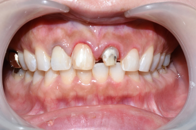 [시청역/광화문]라미네이트케이스:"치아가 작아서 옹졸해 보여요. 치아가 길어보이면 좋겠어요" 관련 이미지 4