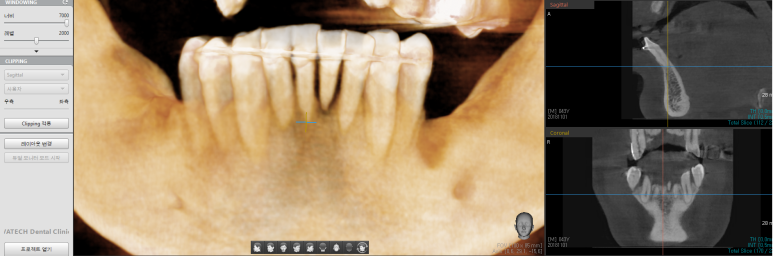 서울 시청치과 시청역/독립문치과 네비게이션임플란트 <연세예감치과> 관련 이미지 2