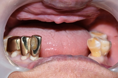 [종로/시청역]실제 환자의 보험 임플란트, 보험 틀니 사례 소개합니다. 젊어지는틀니,임플란트 치료 관련 이미지 3