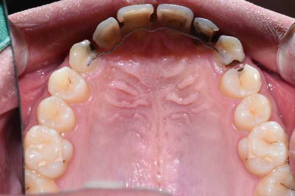 시청역치과 심한 (앞니)충치 치료방법 전후 사례 살펴보아요 관련 이미지 3