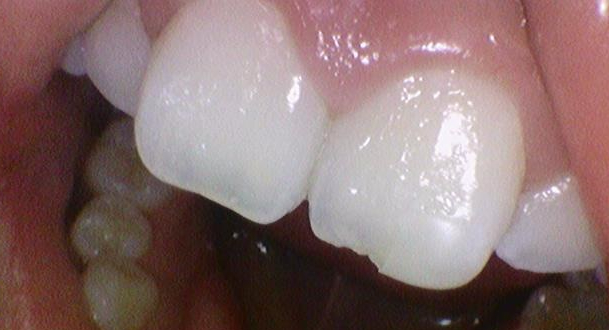 [서울역/치과] 앞니가 조금 아주조금 깨졌어요 치료가능한가요? 관련 이미지 3