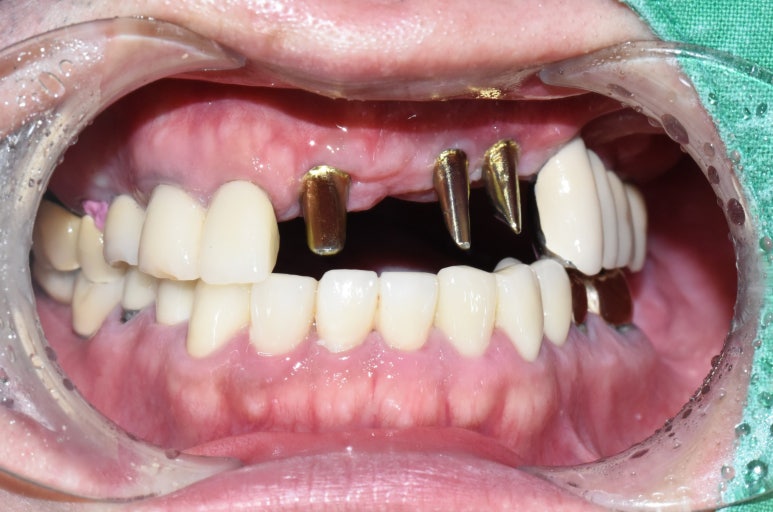 충정로 서울역 근처 고난도 & 재수술 임플란트 수술 치과 관련 이미지 4