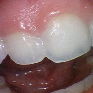 [을지로/명동 근처 치과] 앞니 레진 치료사례 관련 이미지 3
